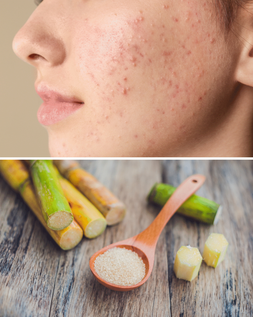 Mau Anti Jerawatan dan Tetap Bisa Ngemil Manis? Trik Cerdasnya Ada di Sini