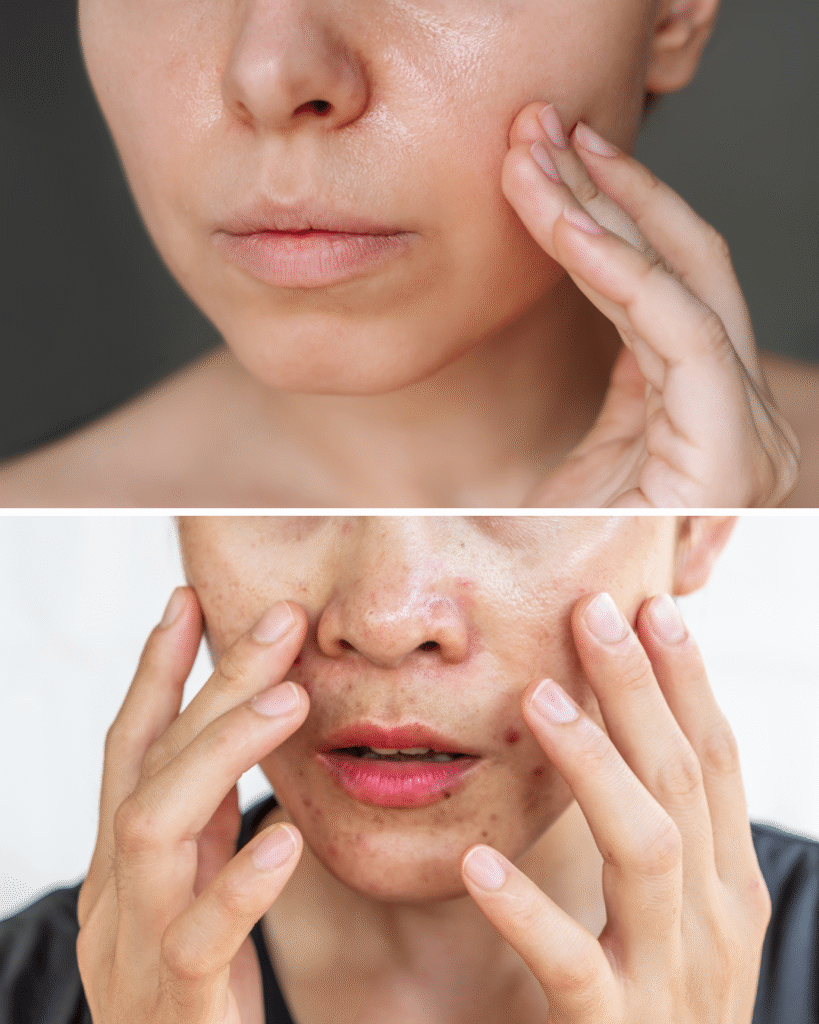 Kulit Berminyak Tapi Dehidrasi? Ini Kesalahan yang Sering Kamu Lakukan!